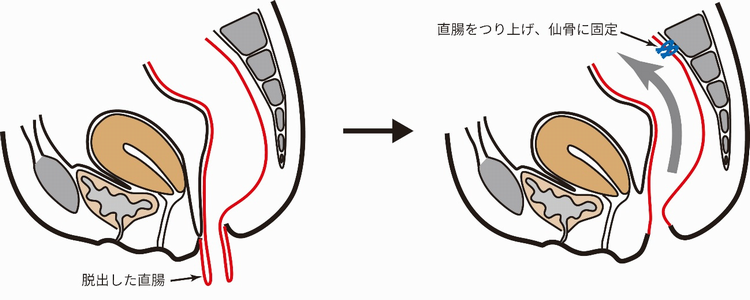 ヘルニア外来のご案内 | 仁恵会石井病院