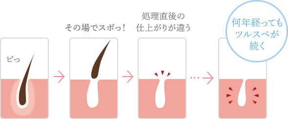 メンズTBCは嘘の評判？2回【3,825本】脱毛した効果の真相を解説！ | ヒゲ脱毛ガイド