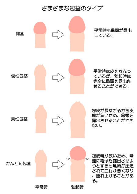 ドリチンとは？ドリチンのデメリットと最善の治療法を徹底解説 | 【フェアクリニック】包茎・薄毛・男の悩み相談所