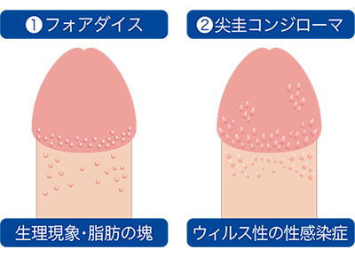 ペニス（亀頭・陰茎）ぶつぶつ除去｜大阪梅田中央クリニック｜大阪駅5分・阪急梅田駅1分