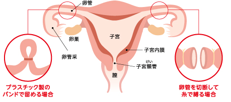 4/4 夫婦の避妊事情をコンドマニアに聞いてみた [男の子育て] All About