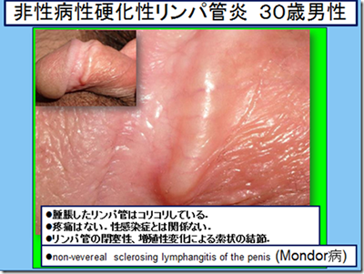 亀頭包皮炎について – メンズ形成外科 |