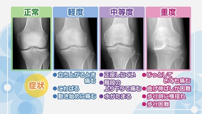 膝痛の改善について | 練馬区の鍼灸ならたった1回で効果を実感できる太陽堂鍼灸マッサージ院練馬へ！