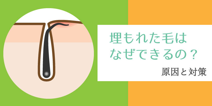 髭を抜くと起きる５つの危険！肌トラブルになったときの対処法も解説 | まるわかりメンズ脱毛