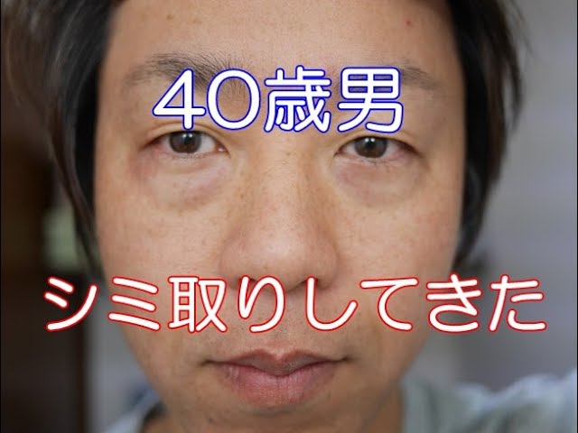 症例写真】額の切開リフトを行った40代男性の症例：美容外科 高須クリニック