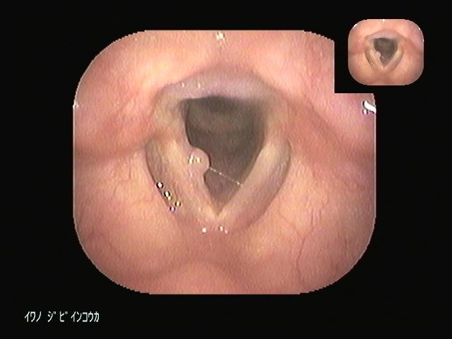 いびきの出やすいノドの形・笠井耳鼻咽喉科クリニック