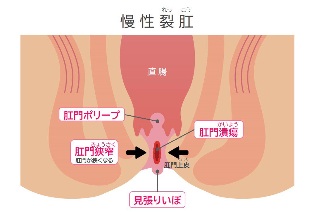 おしり(肛門)疾患説明｜大阪市住吉区あびこ駅前の肛門外科 むらやま大腸肛門クリニック