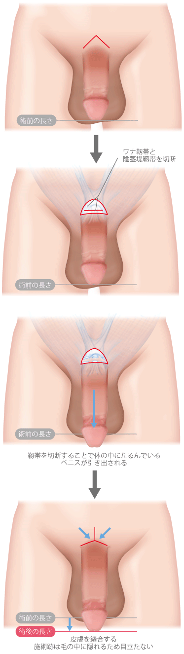 泌尿器科の専門医が解説】ペニス増大手術に関して知っておきたい８つの知識