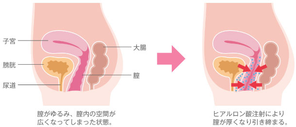 Gスポットはない人もいる!? 見つけ方と感じる方法を婦人科医がレクチャー｜GLITTER | グリッターな人生を！(スタイルマガジン『グリッター』)