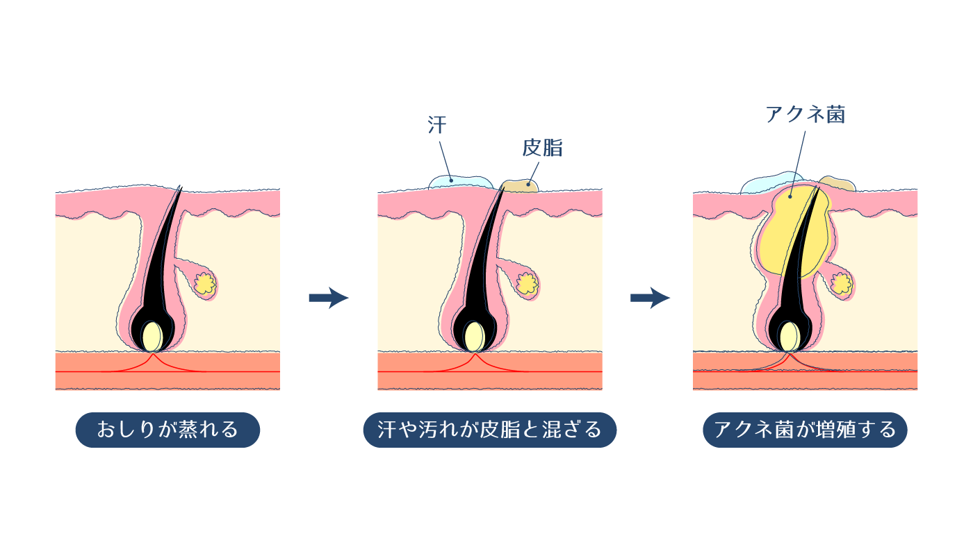 おむつかぶれに効く薬｜ステロイド無配合の塗り薬とその選び方を解説 | お薬専門通販のミナカラ｜オンライン薬局