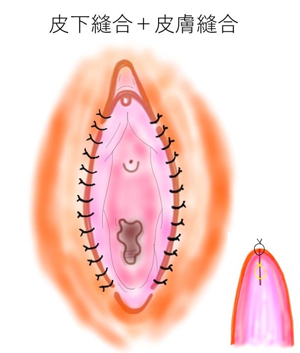 クリトリス（陰核）包茎手術 最安値230,000円 安い！上手い！ 東京