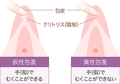 クリトリス包茎術 | 美容皮膚科サクラアズクリニック｜大阪心斎橋・福岡天神