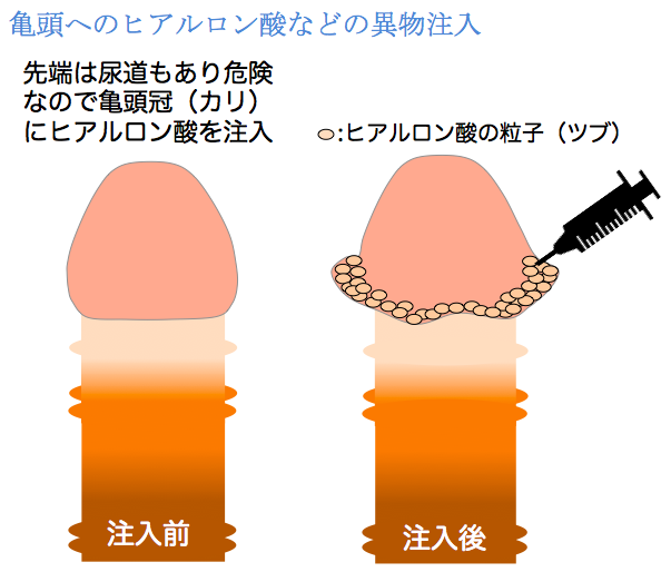 コックリング（ペニスリング）とは？正しい使い方や危険性も徹底解説【医師監修】 | 新橋ファーストクリニック【公式】