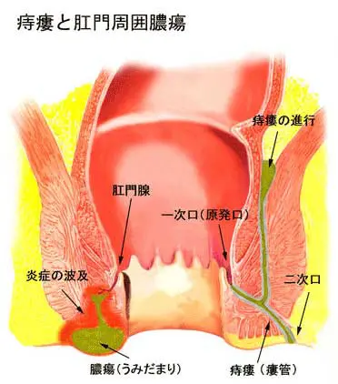 あな痔（痔ろう）｜お尻から膿・お尻が熱い｜三重津駅前つじうら胃腸肛門内視鏡クリニック