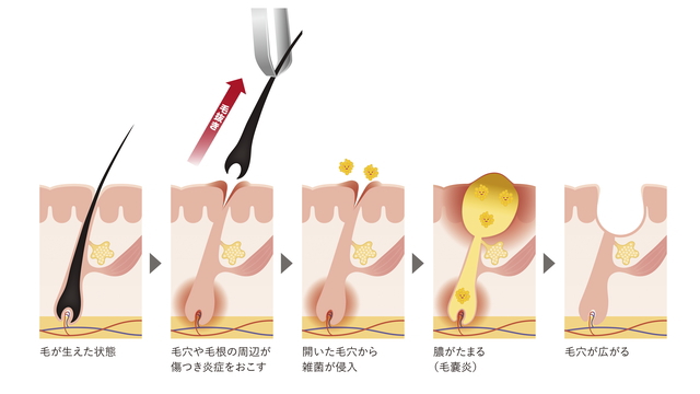 肩の毛が濃い方必見！肩周りの毛の処理なら脱毛がおすすめ！ - 【公式】メンズトータルエステサロン ZELMO(ゼルモ)