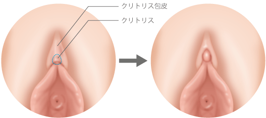 クリトリス包茎で叶える快適なインティメイトケア | ガーデンクリニック