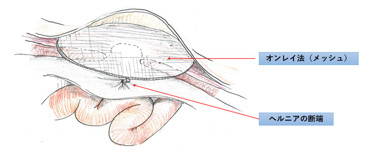鼠径部ヘルニアの手術方法 - そけいヘルニアノート
