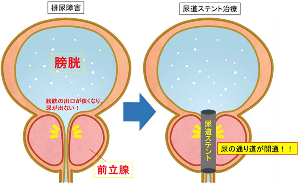 尿道カテーテルQ&A「尿道カテーテル留置中の発熱は尿路感染症？どうやって見分ける？」│看護師ライフをもっとステキに ナースプラス