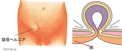 腰痛には、テニスボールを使ってトリガーポイントを刺激。 | 健康 | クロワッサン