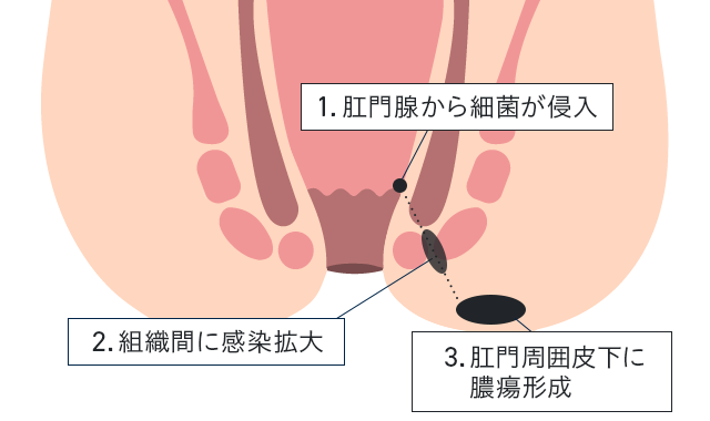 パンツに穴が開く原因 : ガイックとのフランス暮らし