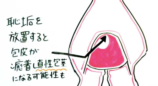 クリトリス包茎手術｜見た目・感度を改善！女性器整形「クリトリス包茎手術」の効果・経過・ダウンタイムとは｜美容整形・美容外科のTAクリニックグループ