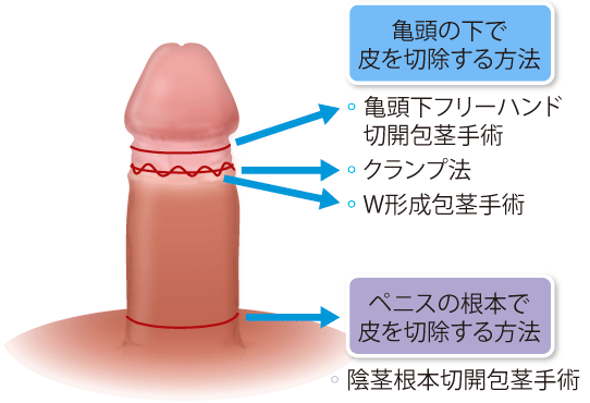 女性の包茎】クリトリス包茎とは？原因や影響を徹底解説！│SELECT CLINIC TIPS