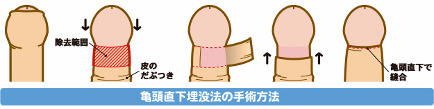 泌尿器科の専門医が解説】包茎手術のペリカン変形に関する原因・予防・修正方法