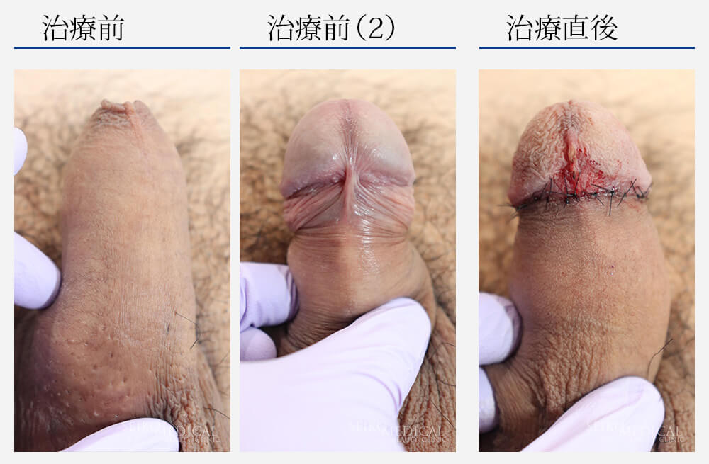 包茎手術で後悔しない人気クリニックと知っておきたい失敗例・デメリット
